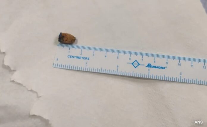 <b>incredible-medical-miracle:-pen-cap-removed-from-man’s-lungs-after-21-years</b>